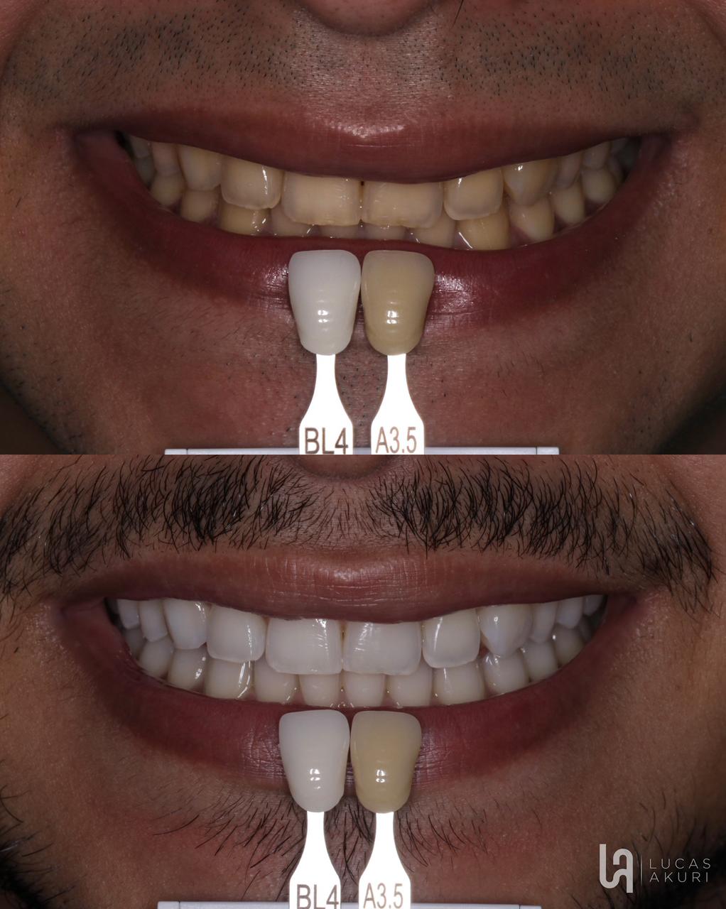 Clareamento dental