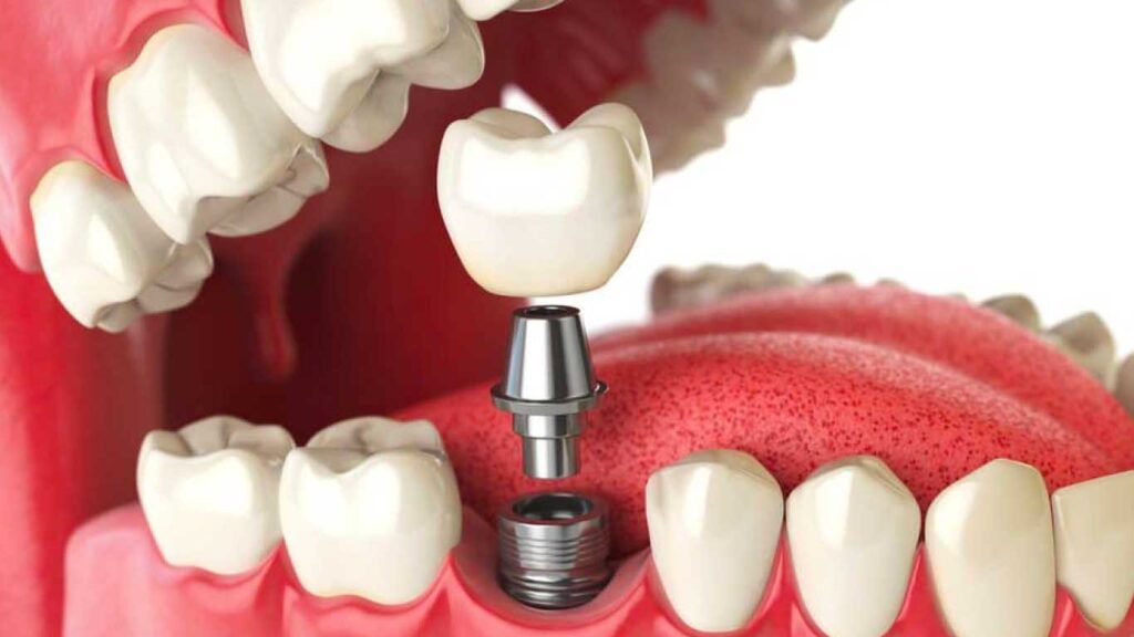 Implante dentário